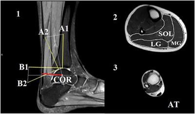 A longer Achilles tendon moment arm length is not associated with superior hopping performance